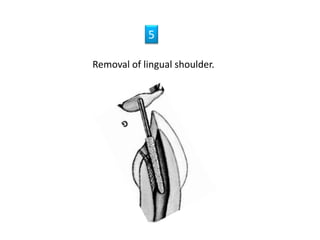 Removal of lingual shoulder.
5
 
