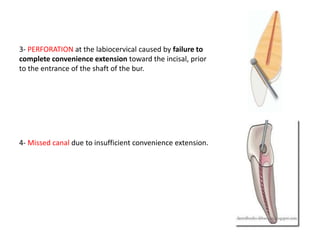 4- Missed canal due to insufficient convenience extension.
3- PERFORATION at the labiocervical caused by failure to
complete convenience extension toward the incisal, prior
to the entrance of the shaft of the bur.
 