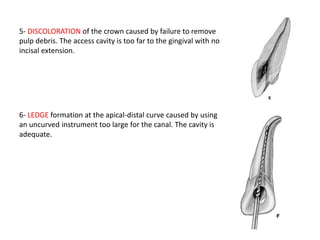 5- DISCOLORATION of the crown caused by failure to remove
pulp debris. The access cavity is too far to the gingival with no
incisal extension.
6- LEDGE formation at the apical-distal curve caused by using
an uncurved instrument too large for the canal. The cavity is
adequate.
 
