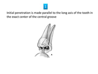 Initial penetration is made parallel to the long axis of the tooth in
the exact center of the central groove
11
 