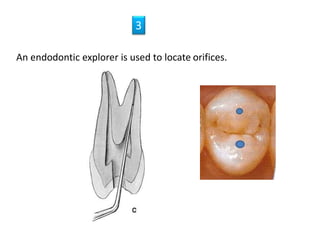 An endodontic explorer is used to locate orifices.
3
 