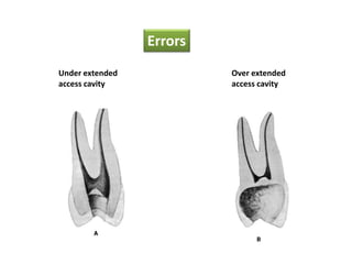 Errors
Under extended
access cavity
Over extended
access cavity
 