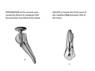 PERFORATION at the cervical area
caused by failure to recognize that
the premolar has tilted to the distal.
FAILURE to locate the third canal of
the maxillary first premolar (6% of
the time).
 