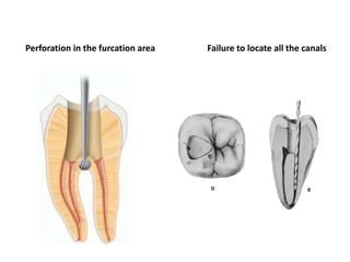 Perforation in the furcation area Failure to locate all the canals
 