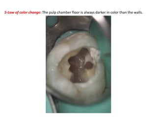 5-Law of color change: The pulp chamber floor is always darker in color than the walls.
 
