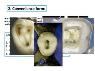 2. Convenience form:
It is the form given to the access cavity to improve visibility, instrumentation and
obturation of the root canal by providing a straight line access from occlusal surface
to the apical foramen.
Benefits:
1. Unobstructed access to the orifices.
2. Direct access to the apical foramina.
3. Complete authority over the instrument.
4. Expansion to accommodate filling techniques.
 