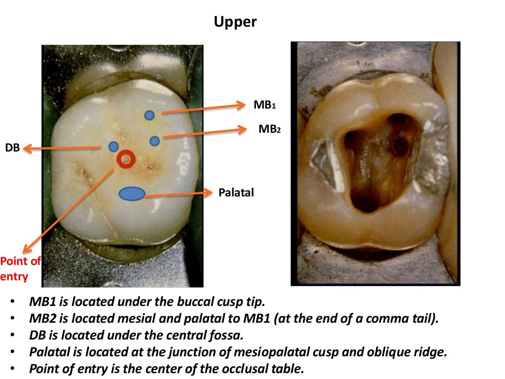 Access cavity preparation