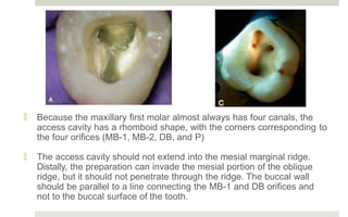 Maxillary First Molar Marginal Ridges accesscavitypreparation-190304123309 (1).pptx
