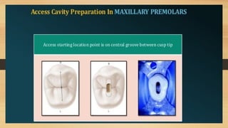 Access Cavity Preparation of anterior and posterior teeth | PPTX