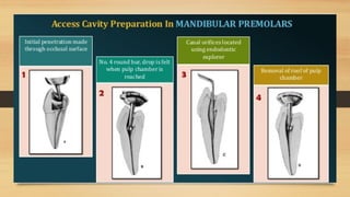 Access Cavity Preparation of anterior and posterior teeth | PPTX