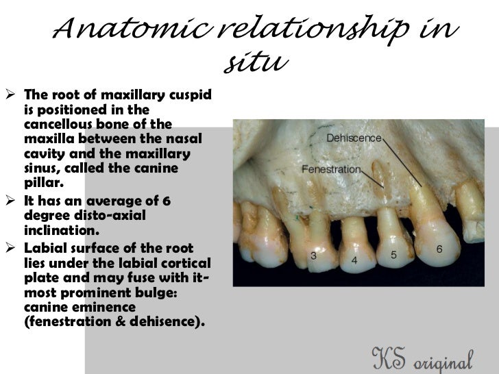 Access cavity preparation for maxillary canines