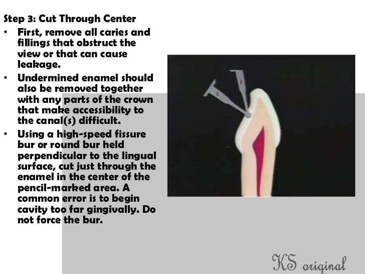 Access cavity preparation for maxillary canines