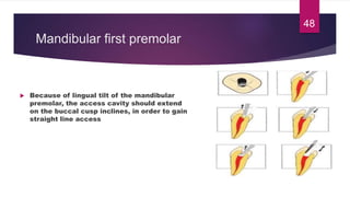 Mandibular first premolar
 Because of lingual tilt of the mandibular
premolar, the access cavity should extend
on the buccal cusp inclines, in order to gain
straight line access
48
 