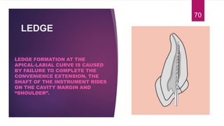 LEDGE
LEDGE FORMATION AT THE
APICAL-LABIAL CURVE IS CAUSED
BY FAILURE TO COMPLETE THE
CONVENIENCE EXTENSION. THE
SHAFT OF THE INSTRUMENT RIDES
ON THE CAVITY MARGIN AND
“SHOULDER”.
70
 