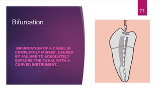 Bifurcation
BIFURCATION OF A CANAL IS
COMPLETELY MISSED, CAUSED
BY FAILURE TO ADEQUATELY
EXPLORE THE CANAL WITH A
CURVED INSTRUMENT.
71
 