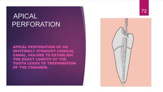 APICAL
PERFORATION
APICAL PERFORATION OF AN
INVITINGLY STRAIGHT CONICAL
CANAL. FAILURE TO ESTABLISH
THE EXACT LENGTH OF THE
TOOTH LEADS TO TREPHINATION
OF THE FORAMEN.
72
 