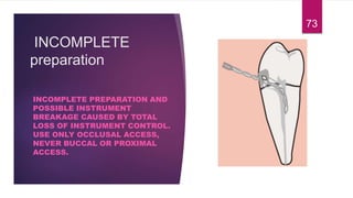 INCOMPLETE
preparation
INCOMPLETE PREPARATION AND
POSSIBLE INSTRUMENT
BREAKAGE CAUSED BY TOTAL
LOSS OF INSTRUMENT CONTROL.
USE ONLY OCCLUSAL ACCESS,
NEVER BUCCAL OR PROXIMAL
ACCESS.
73
 