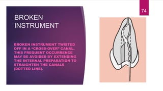 BROKEN
INSTRUMENT
BROKEN INSTRUMENT TWISTED
OFF IN A “CROSS-OVER” CANAL.
THIS FREQUENT OCCURRENCE
MAY BE AVOIDED BY EXTENDING
THE INTERNAL PREPARATION TO
STRAIGHTEN THE CANALS
(DOTTED LINE).
74
 