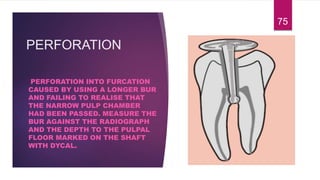 PERFORATION
PERFORATION INTO FURCATION
CAUSED BY USING A LONGER BUR
AND FAILING TO REALISE THAT
THE NARROW PULP CHAMBER
HAD BEEN PASSED. MEASURE THE
BUR AGAINST THE RADIOGRAPH
AND THE DEPTH TO THE PULPAL
FLOOR MARKED ON THE SHAFT
WITH DYCAL.
75
 