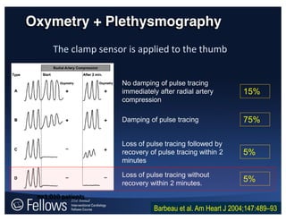 Oxymetry + Plethysmography
No damping of pulse tracing
immediately after radial artery
compression
Damping of pulse tracing
Loss of pulse tracing followed by
recovery of pulse tracing within 2
minutes
Loss of pulse tracing without
recovery within 2 minutes.
The clamp sensor is applied to the thumb
Barbeau et al. Am Heart J 2004;147:489–93
15%
75%
5%
5%
n=1,010 patients
 