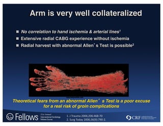 Arm is very well collateralized
 No correlation to hand ischemia & arterial lines1
 Extensive radial CABG experience without ischemia
 Radial harvest with abnormal Allen’s Test is possible2
Theoretical fears from an abnormal Allen’s Test is a poor excuse
for a real risk of groin complications
1. J Trauma 2006;206:468-70
2. Surg Today 2006;36(9):790-2.
Gunther von Hagens, Institute for Plastination, Heidelberg, Germany,
www.bodyworlds.com
 
