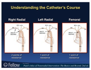 Understanding  the  Catheter’s  Course
2 points of
resistance
1 point of
resistance
1 point of
resistance
Right Radial Left Radial Femoral
Patel's Atlas of Transradial Intervention: The Basics and Beyond. 2nd ed.
 