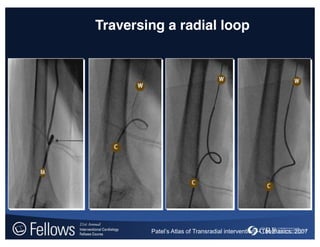 Patel’s  Atlas  of  Transradial  intervention  – The Basics. 2007
Traversing a radial loop
 