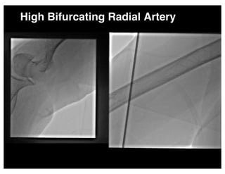 High Bifurcating Radial Artery
 