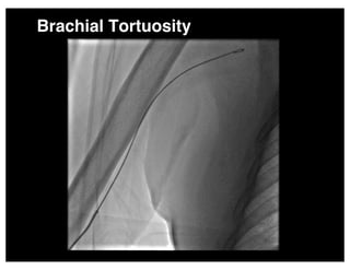 Brachial Tortuosity
 