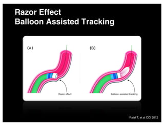 Razor Effect
Balloon Assisted Tracking
Patel T, et al CCI 2012
 