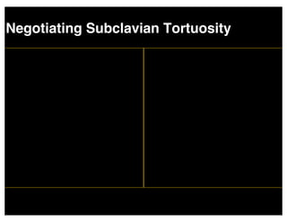 Negotiating Subclavian Tortuosity
 