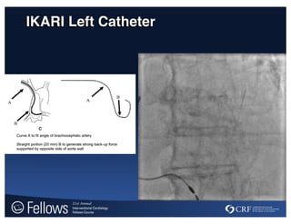 IKARI Left Catheter
 