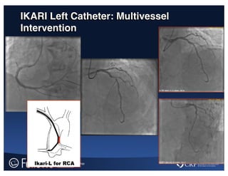 IKARI Left Catheter: Multivessel
Intervention
 