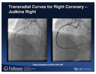 ITS 2011
Transradial Curves for Right Coronary –
Judkins Right
Deep intubation of RCA with JR4
 