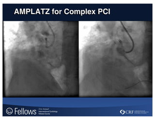 AMPLATZ for Complex PCI
 
