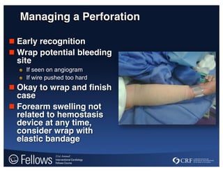Managing a Perforation
 Early recognition
 Wrap potential bleeding
site
If seen on angiogram
If wire pushed too hard
 Okay to wrap and finish
case
 Forearm swelling not
related to hemostasis
device at any time,
consider wrap with
elastic bandage
 