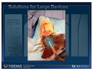 Solutions for Large Devices
 