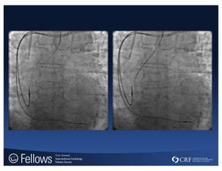 Cohen MG - Transradial access - 201507