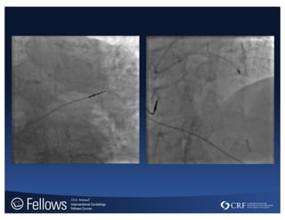 Cohen MG - Transradial access - 201507