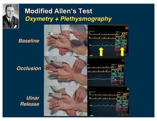 Modified  Allen’s  Test
Oxymetry + Plethysmography
Baseline
Occlusion
Ulnar
Release
 