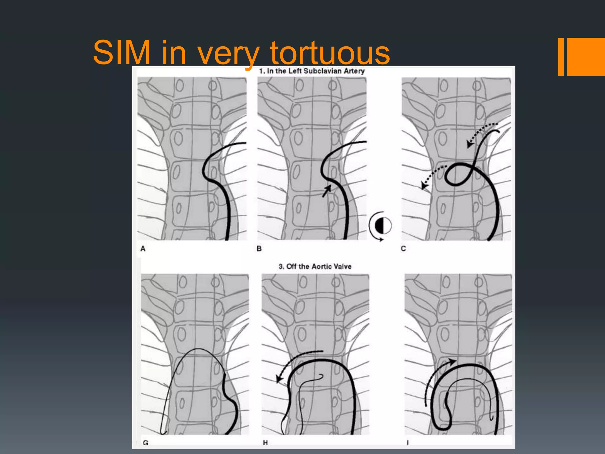 SIM in very tortuous
 