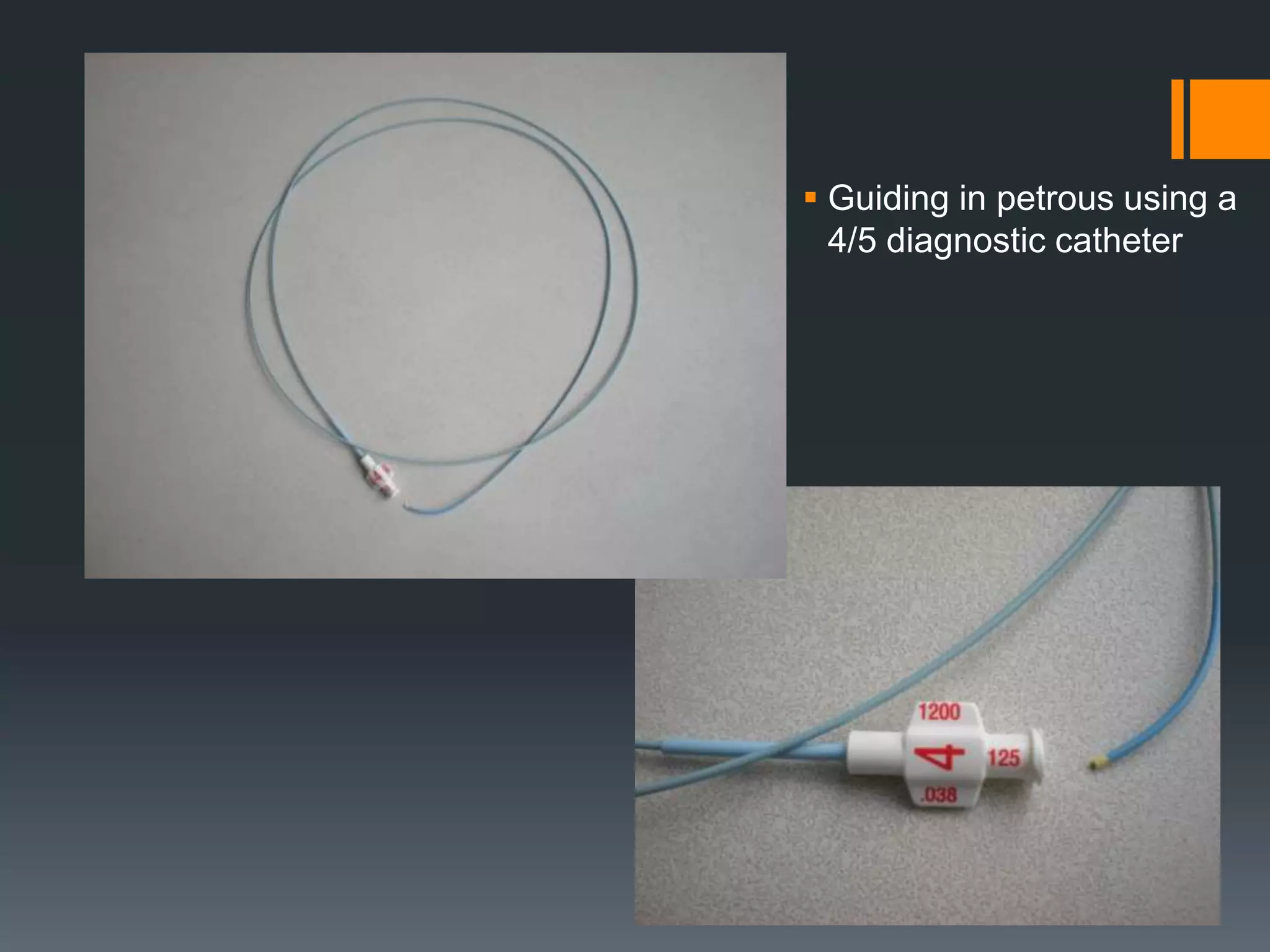 guiding
 Guiding in petrous using a
4/5 diagnostic catheter
 