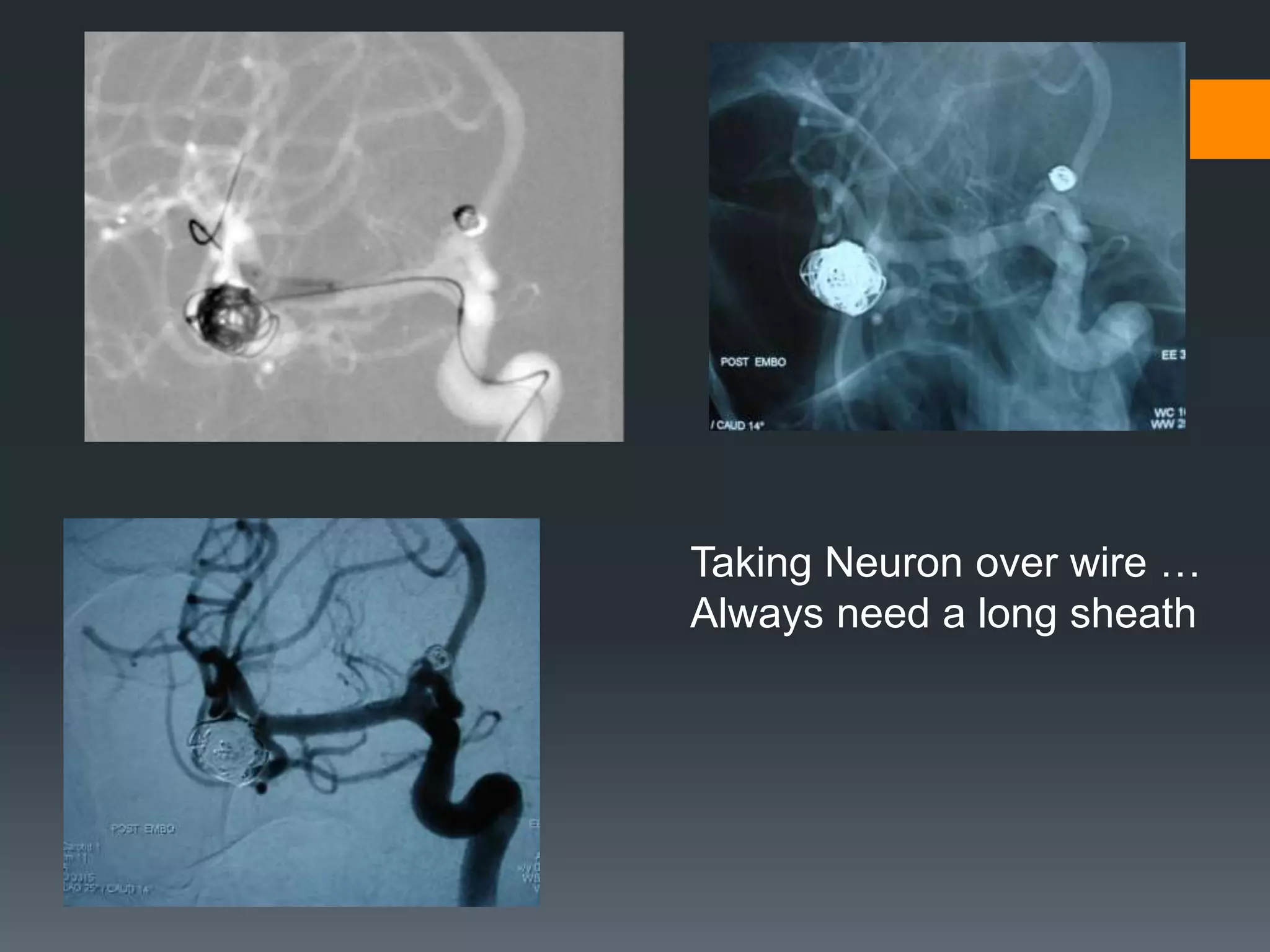 Taking Neuron over wire …
Always need a long sheath
 