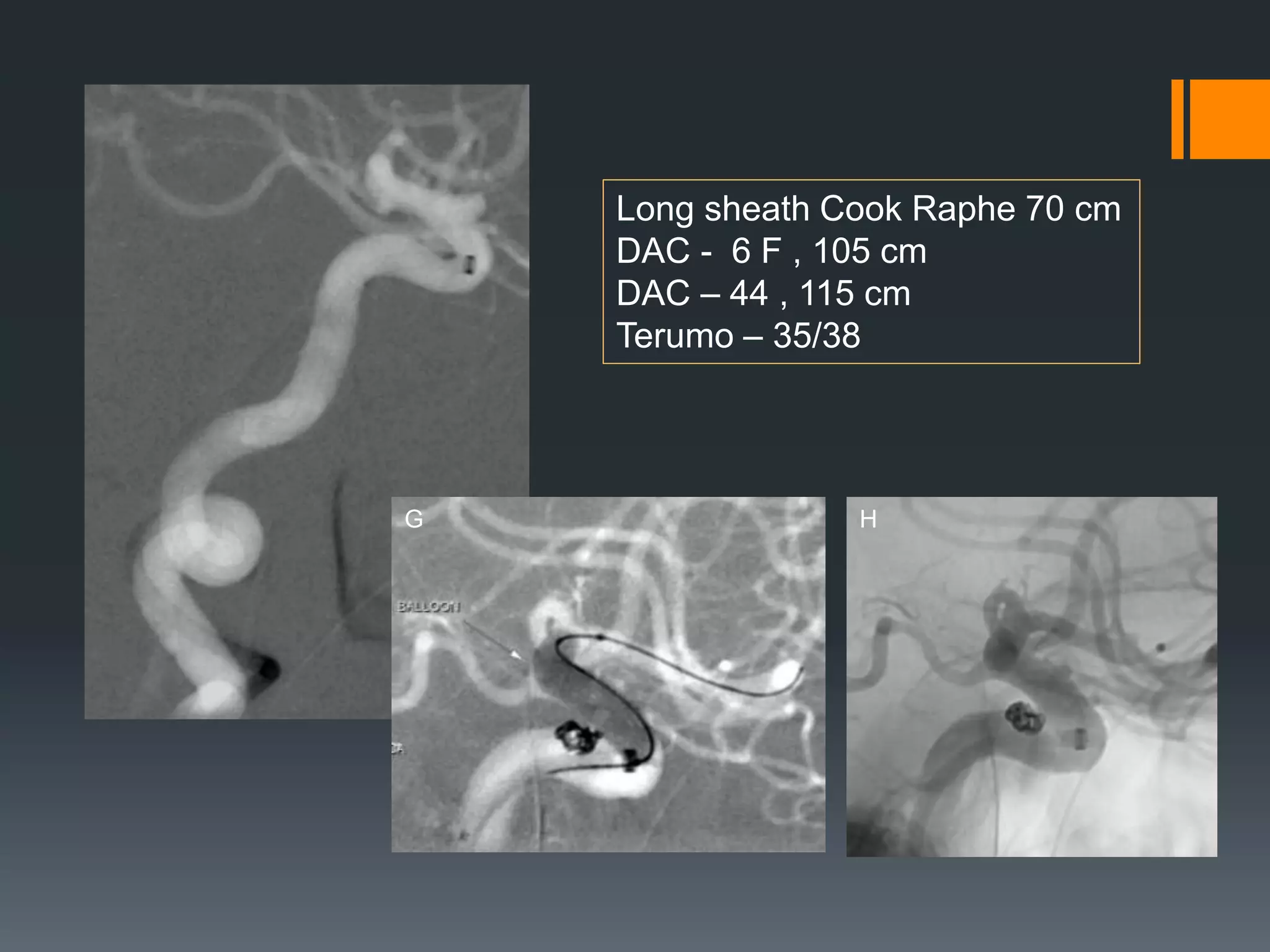 G H
Long sheath Cook Raphe 70 cm
DAC - 6 F , 105 cm
DAC – 44 , 115 cm
Terumo – 35/38
 