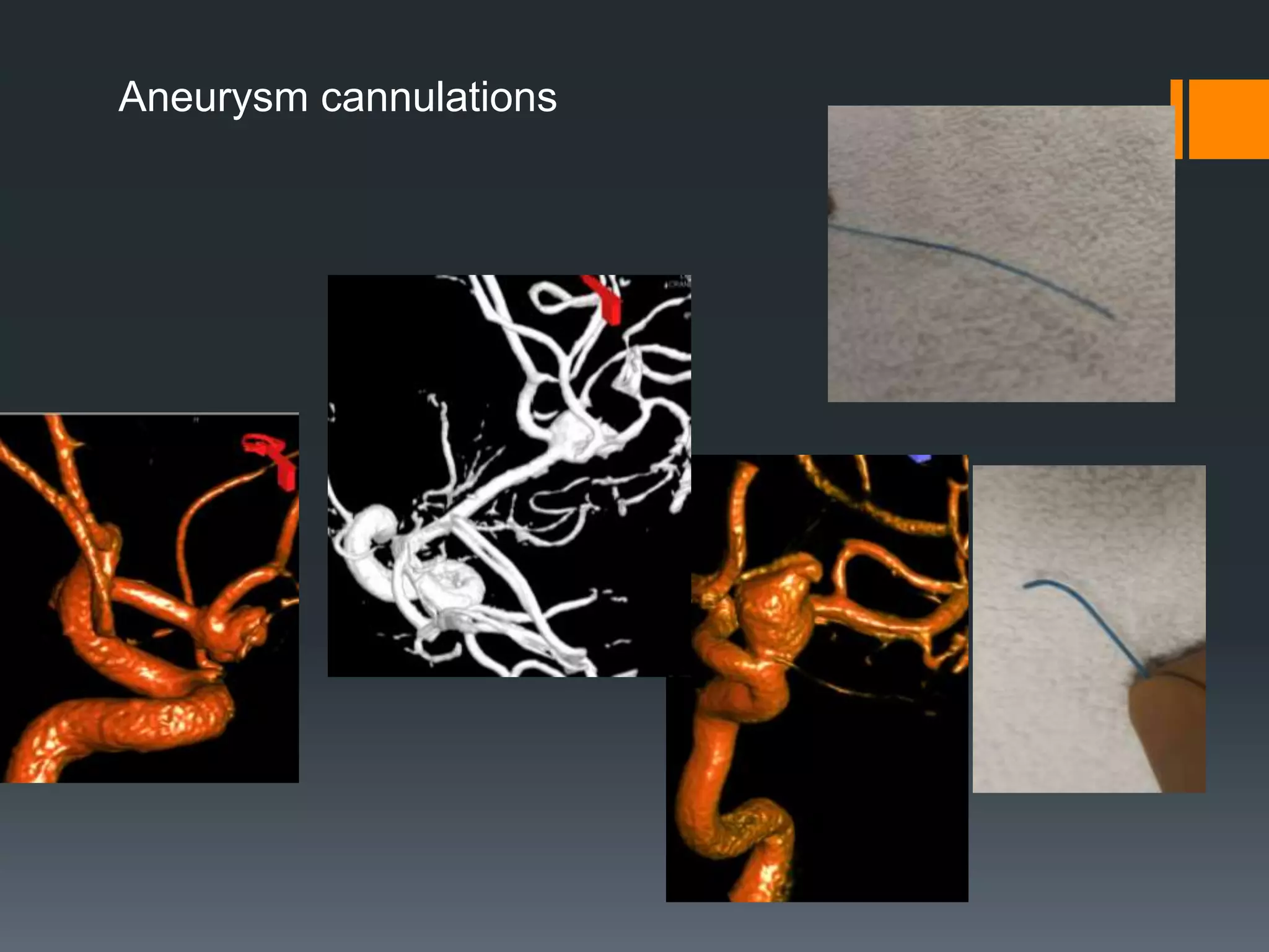 Aneurysm cannulations
 