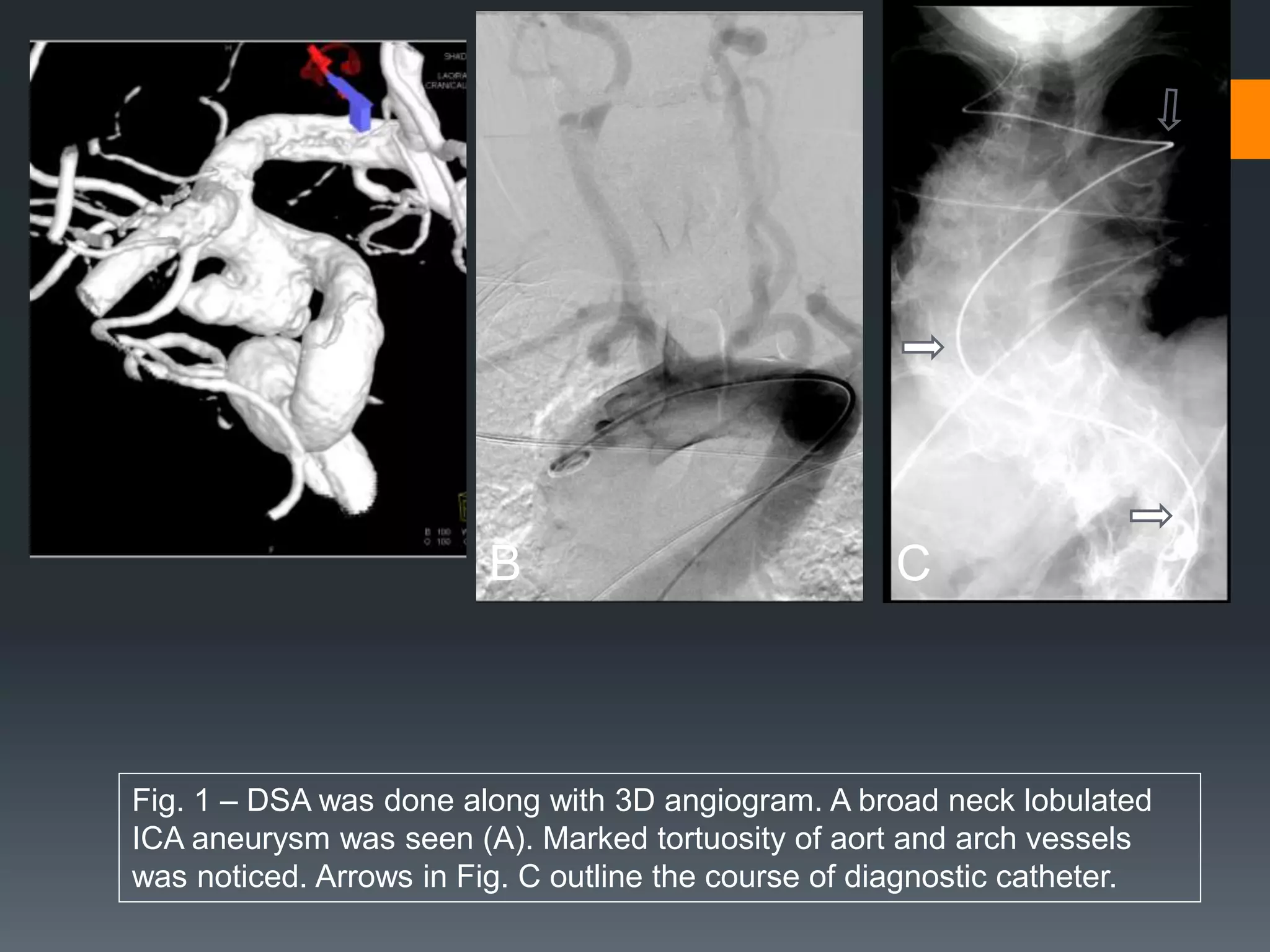 A
B C
Fig. 1 – DSA was done along with 3D angiogram. A broad neck lobulated
ICA aneurysm was seen (A). Marked tortuosity of aort and arch vessels
was noticed. Arrows in Fig. C outline the course of diagnostic catheter.
 