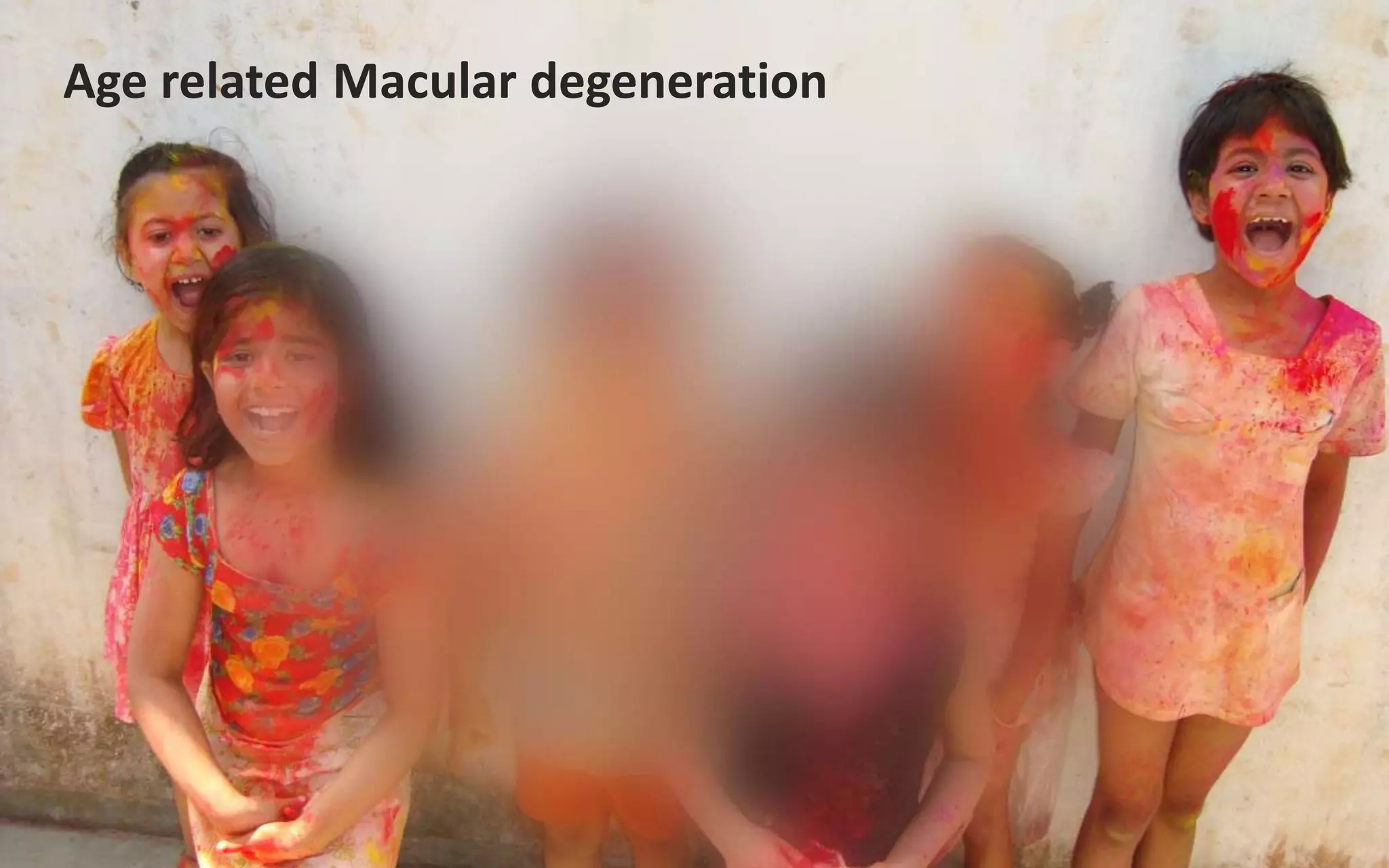 Age related Macular degeneration
 