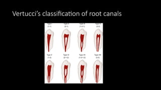 Root Canal Classification access opening & anatomy of root canalss | PPTX