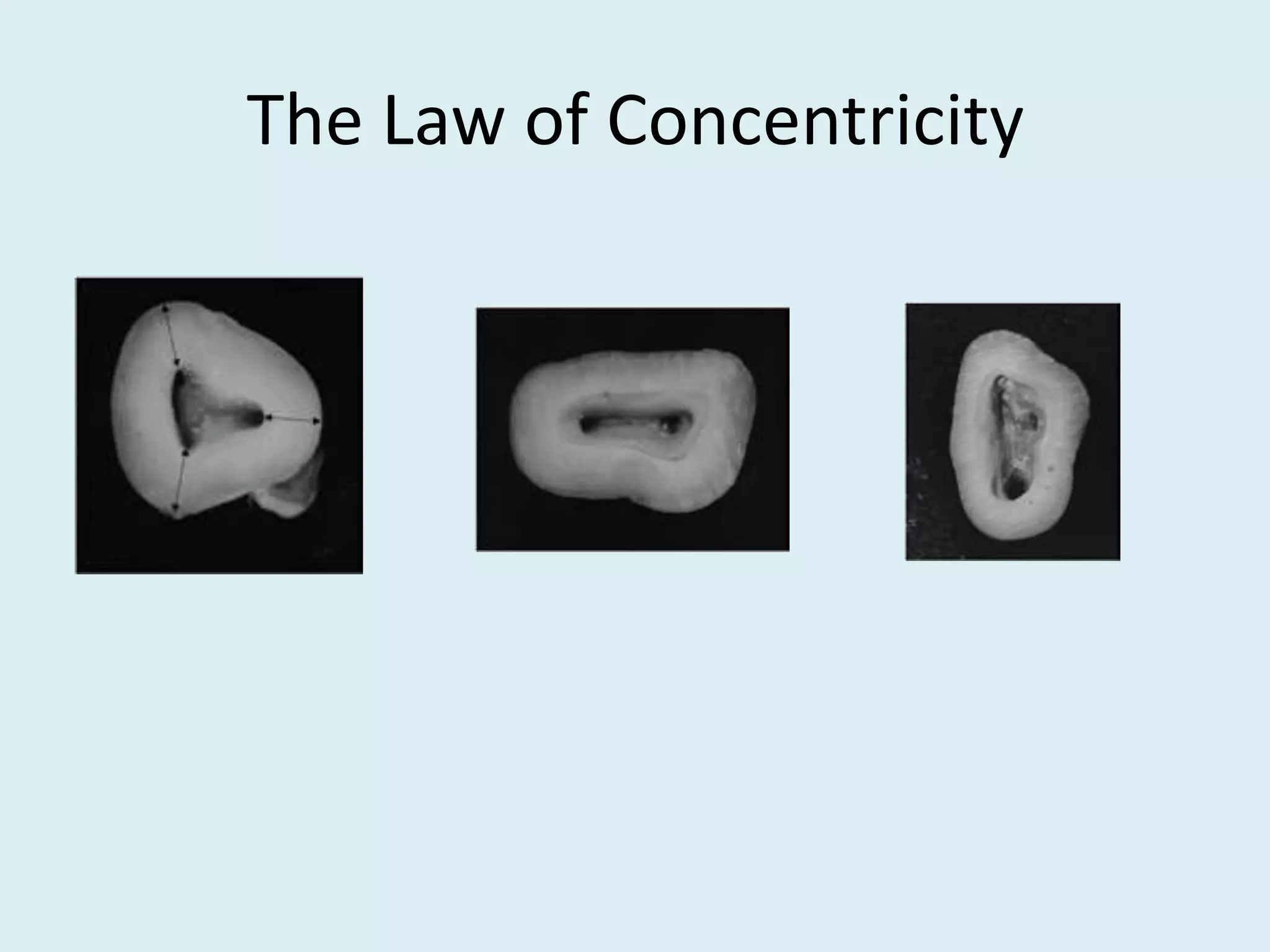 Endo Map Rct Access opening for RCT | PPTX