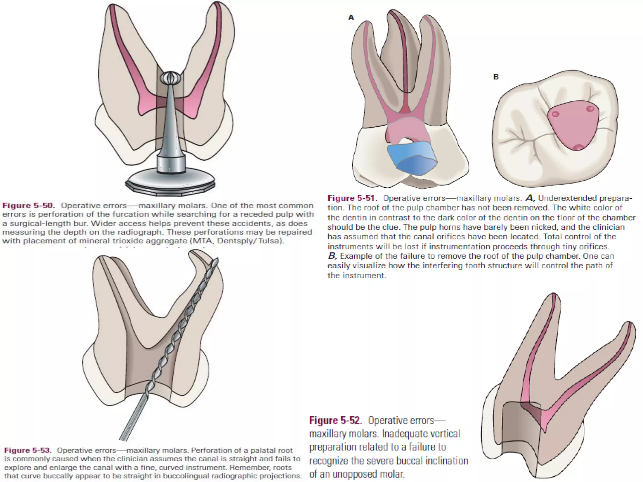 Access opening of molar teeth PDF